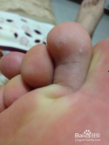 挖脚鸡眼视频,传统疗法与现代视角的碰撞