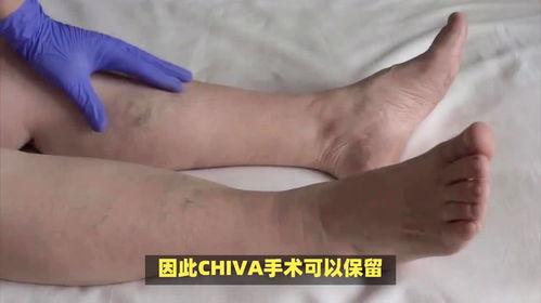 静脉曲张手术视频,专业视频带你直观了解