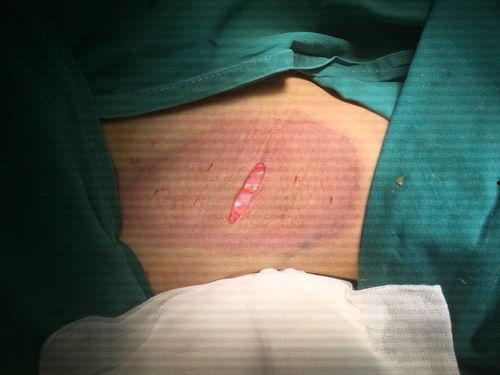 狐臭手术视频,专业视频带你了解祛除狐臭的奥秘