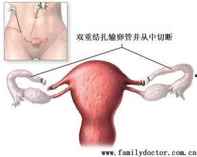 开腹式输卵管结扎视频,开腹式输卵管结扎手术过程详解