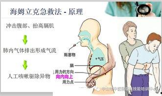 海姆立克急救法的标准动作视频,关键时刻的救命技能演示