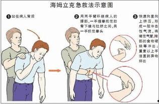 海姆立克急救法的标准动作视频,关键时刻的救命技能演示